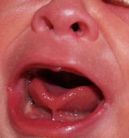 Tongue-tied baby may be less successful breastfeeder