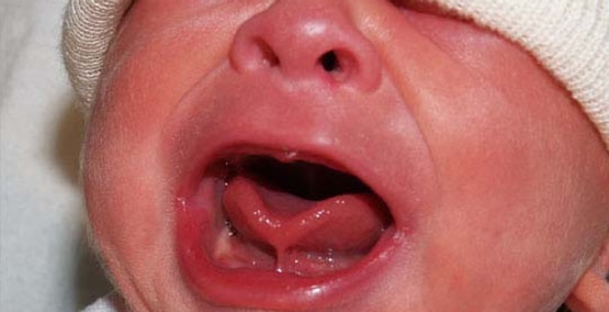 Tongue-tied baby may be less successful breastfeeder