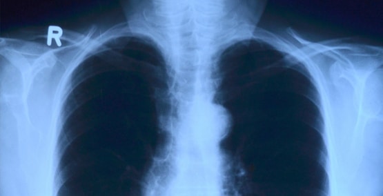 Cystic fibrosis lung transplants