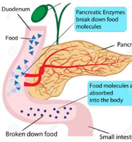 Causes of exocrine pancreatic insufficiency ( EPI)