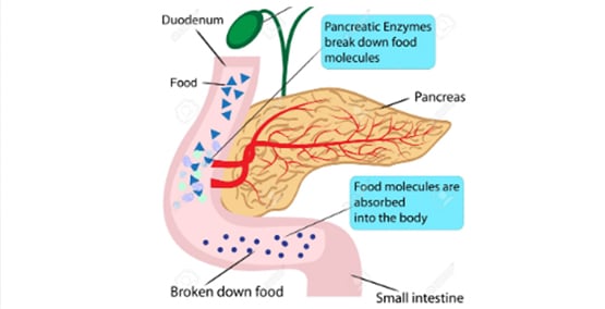 Causes of exocrine pancreatic insufficiency