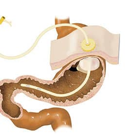 Tube-feedings for kids who aspirate – When kids with swallowing problems need a tube for feedings